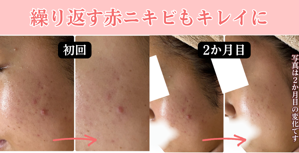 繰り返す赤ニキビの女性のビフォーアフター写真