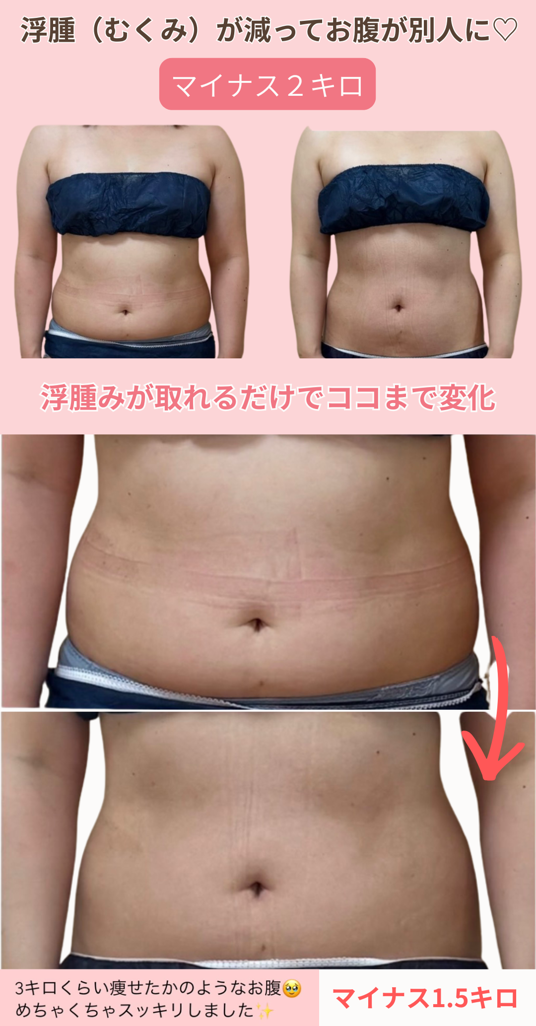 むくみが取れて体重が１㎏～３㎏落ちたビフォーアフターの写真