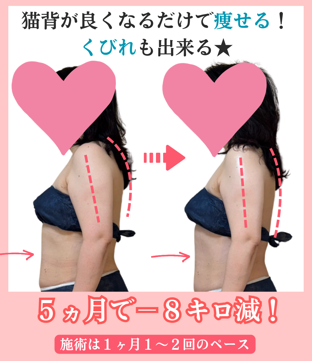 猫背を改善して痩せたビフォーアフター（左横から見た写真）
