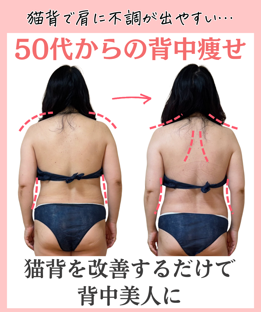 猫背・姿勢が改善した50代女性のビフォーアフターの画像（背中側）