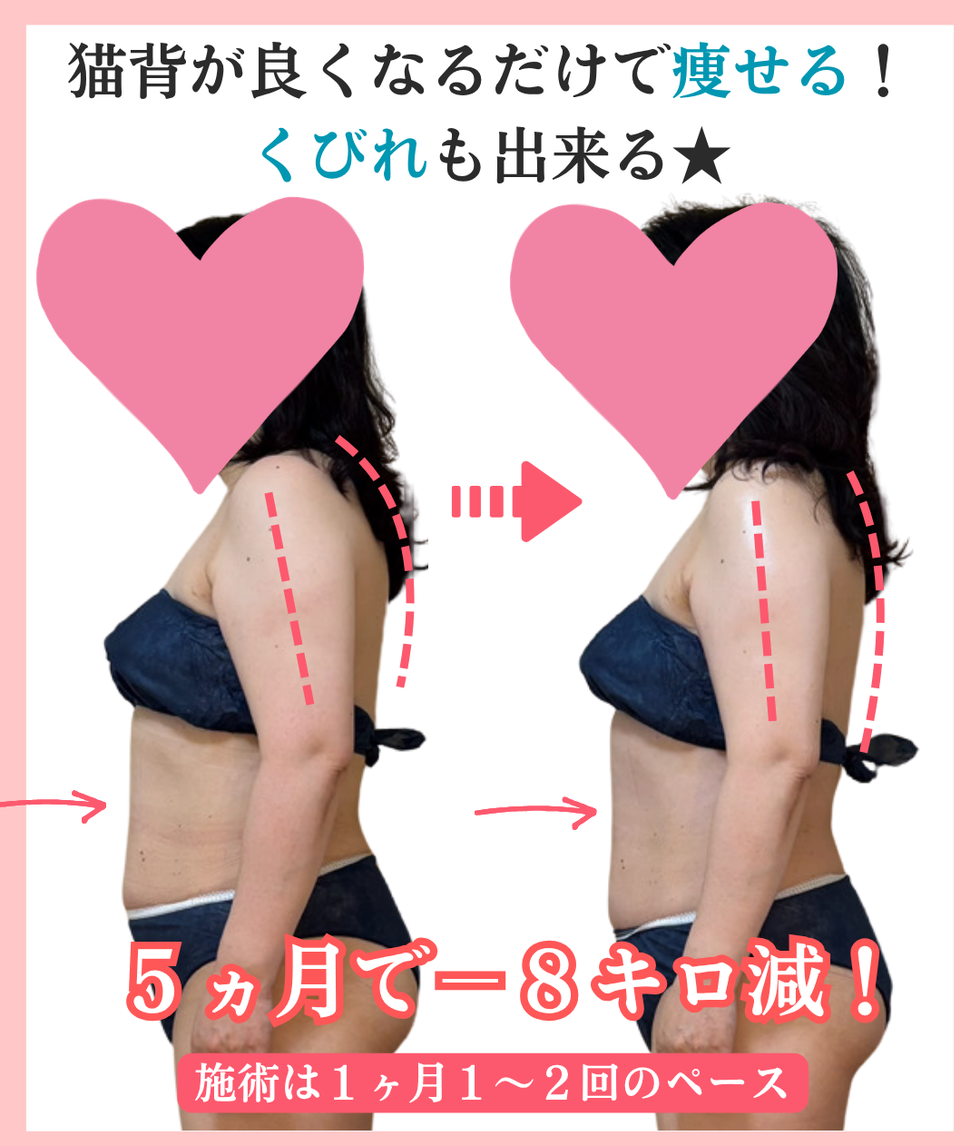 猫背・姿勢が改善した50代女性のビフォーアフターの画像（背中側）