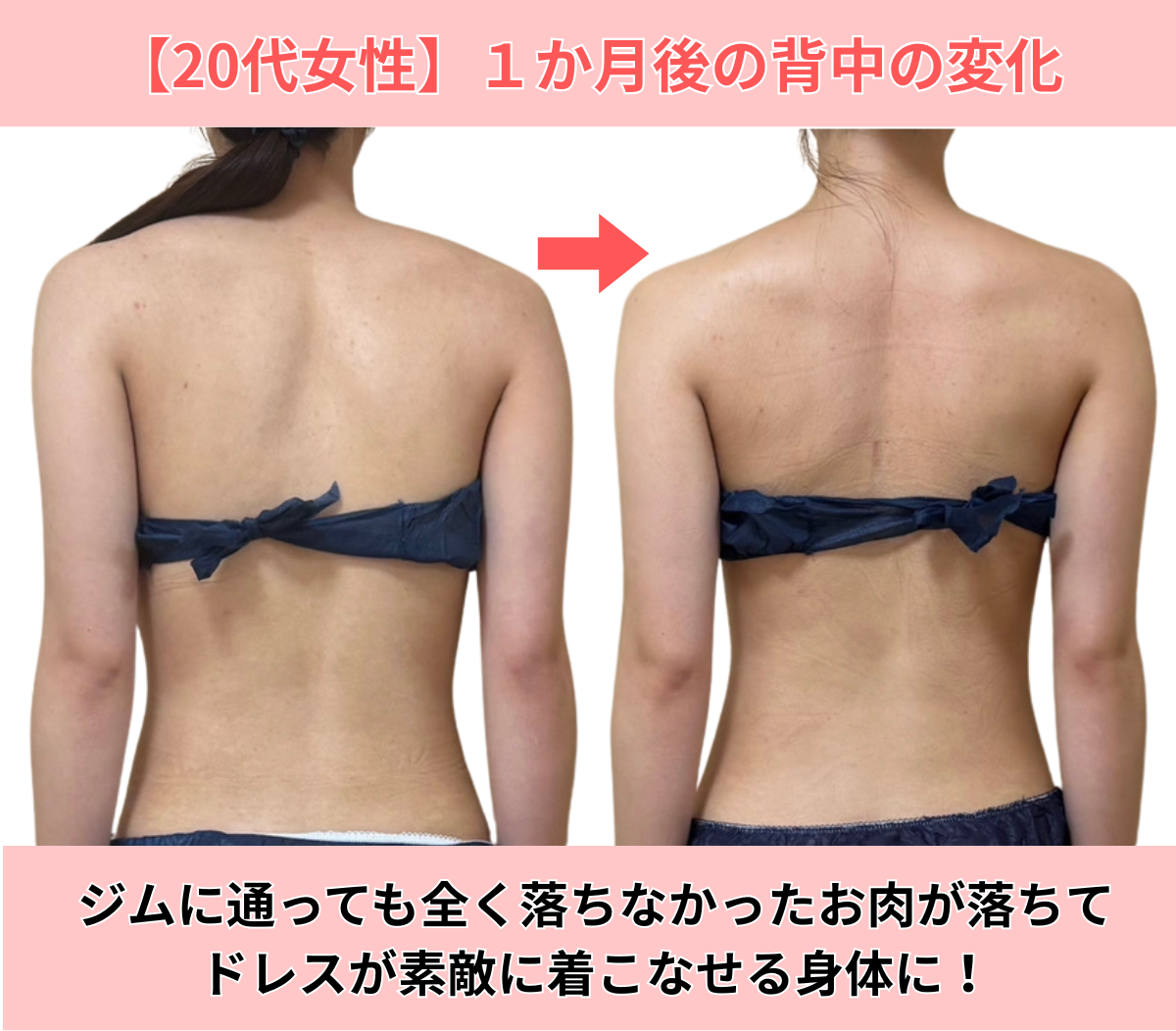 【20代女性】背中のお肉のビフォーアフター画像