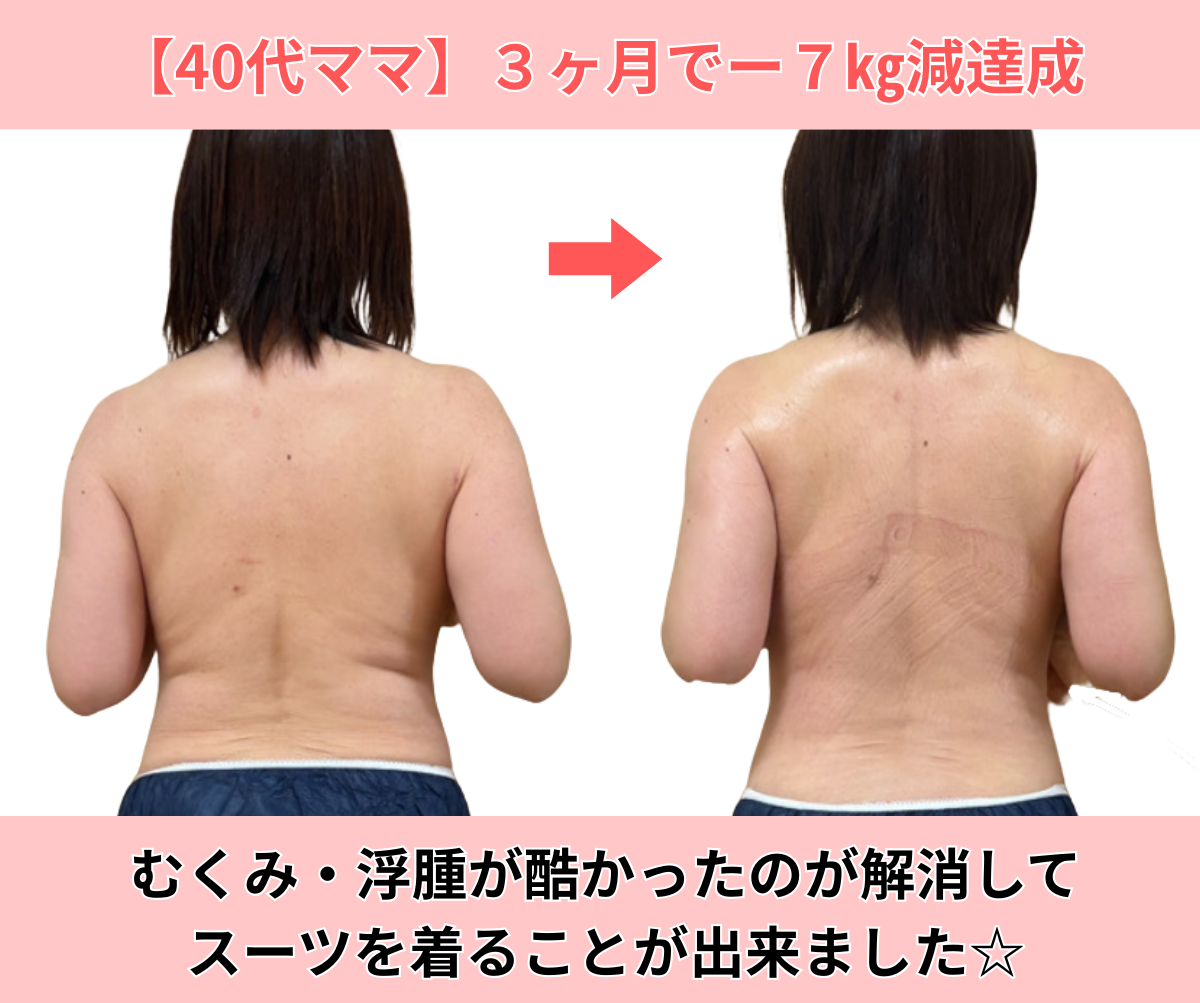 【40代女性】背中のお肉のビフォーアフター画像