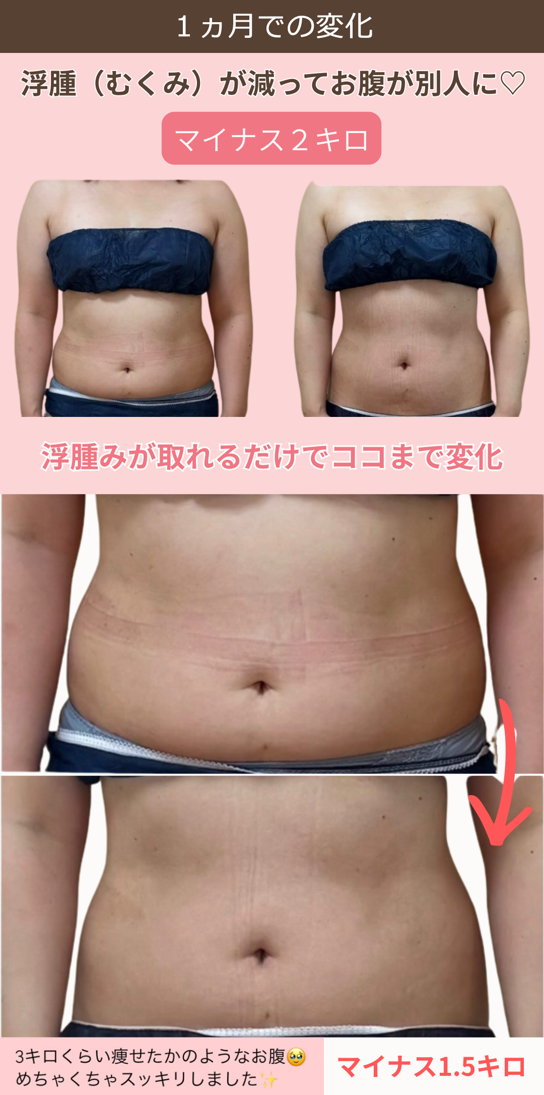 むくみを解消しただけで、お腹が別人級になったお客様のビフォーアフター写真