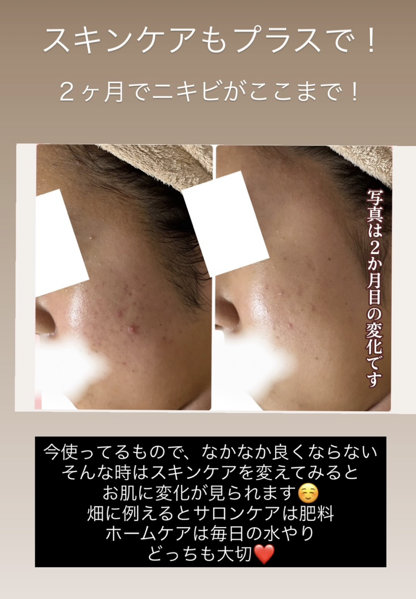 ニキビ肌2か月目の変化