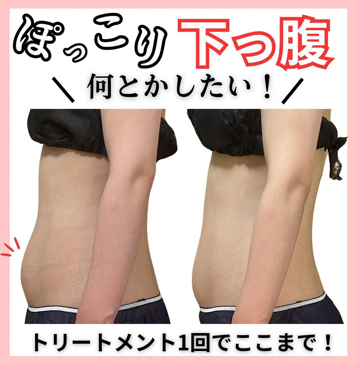 ぽっこりお腹・下腹痩せビフォーアフター１回の変化