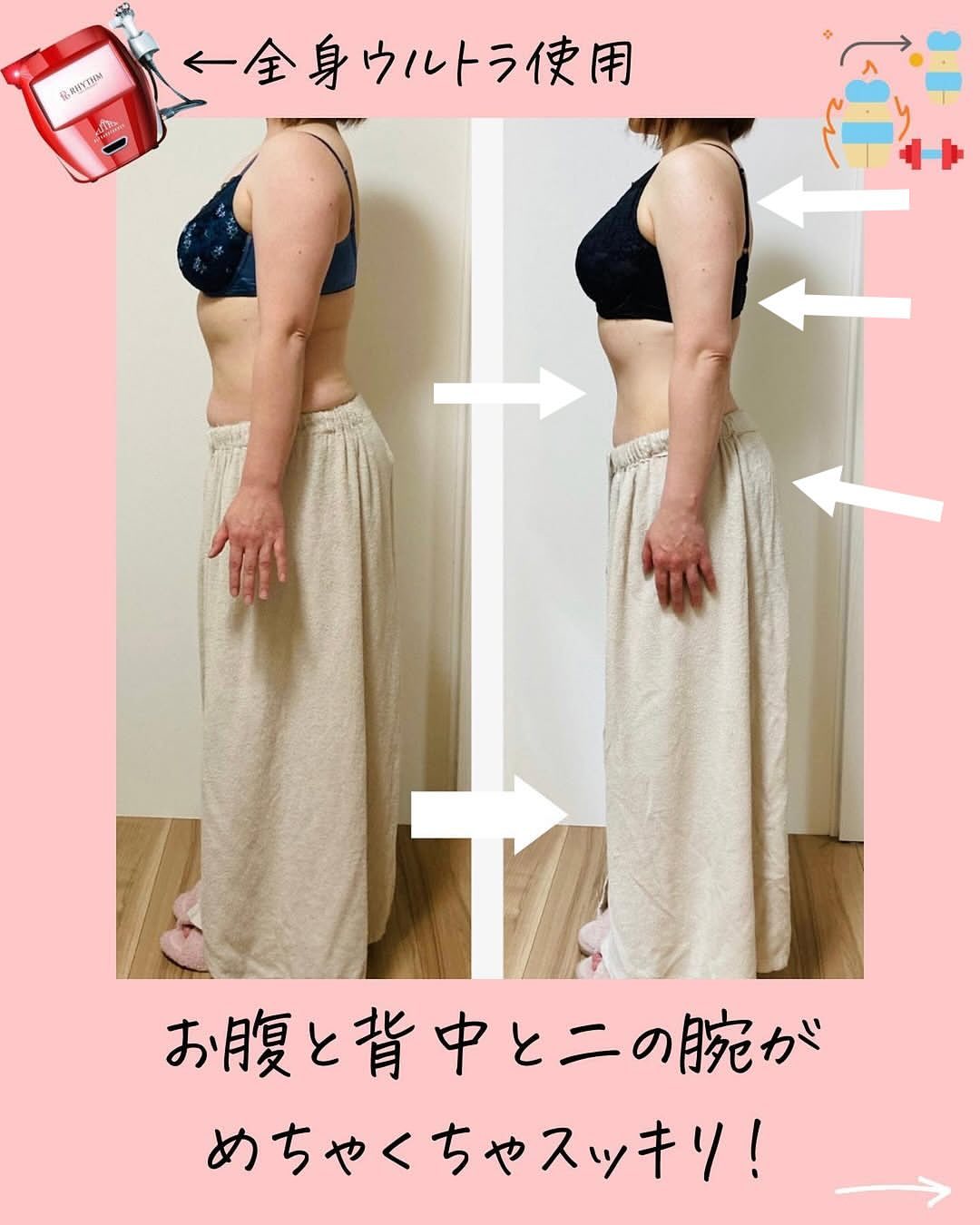 横から見た３ヵ月でぽっこりお腹・下腹痩せ解消したビフォーアフター写真