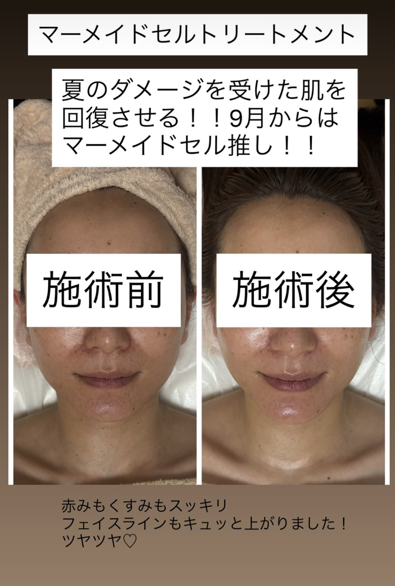 マーメイドセルトリートメントのビフォーアフター画像