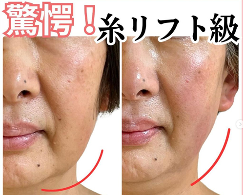 リフトアップしたビフォーアフター画像